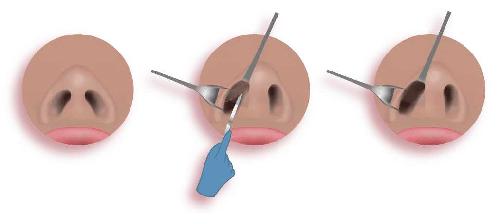 noseclose-technique